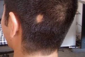 Haarausfall Alopecia areata kahle Stelle kaschieren
