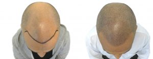 Haarpigmentierung Berlin Alternative Haartransplantation, Barttransplantation