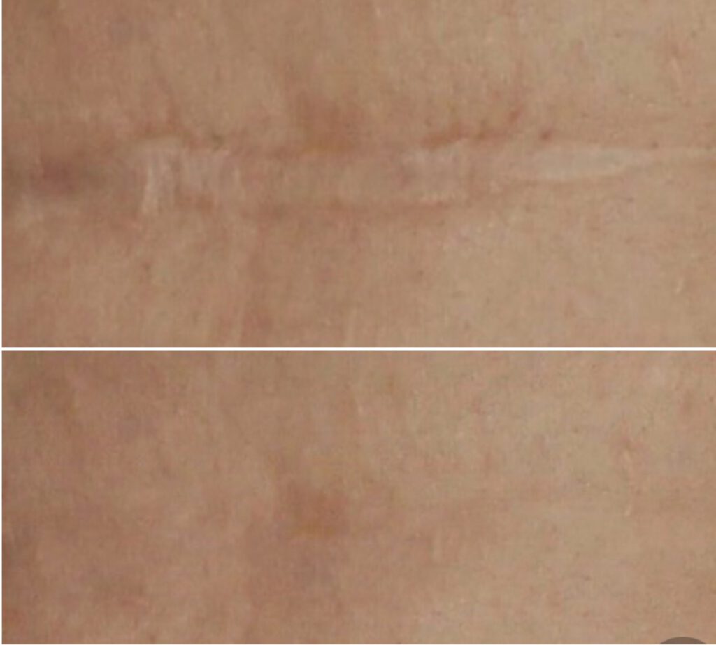 Permanent Make Up für Narbenkorrektur PMU Berlin