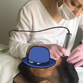 Haarauffüllung & Trichopigmentierung Deutschland Berlin Haarauffüllung & Trichopigmentierung Deutschland Berlin Vorher-Nachher