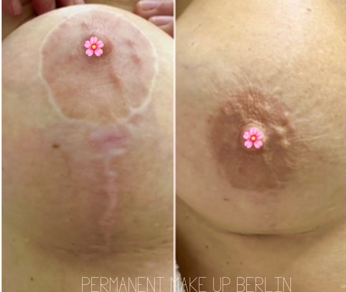 Mamillenrekonstruktion & Areola Narben Pigmentierung Deutschland Berlin⁠