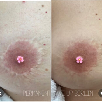 Mamillenrekonstruktion & Areola Narben Pigmentierung Deutschland Berlin Mamillenrekonstruktion & Areola Narben Pigmentierung Deutschland Berlin