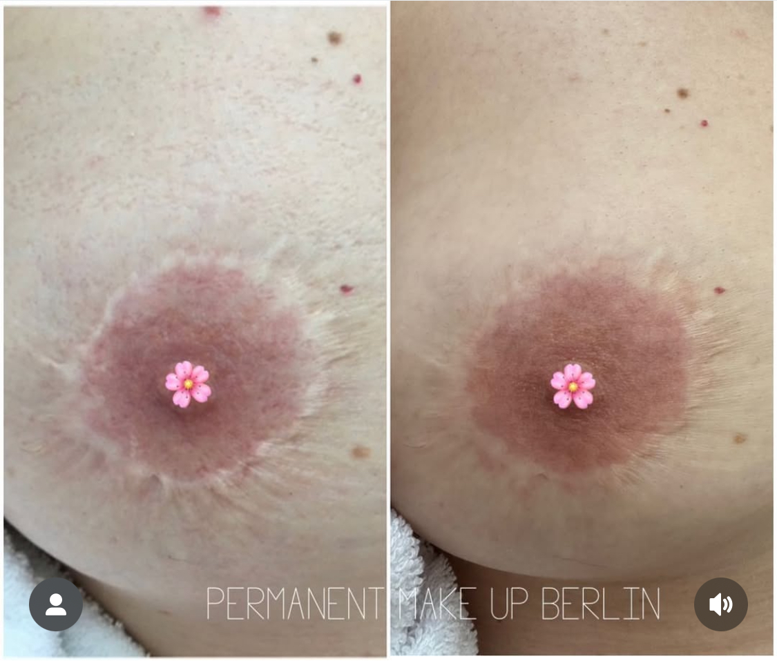 Mamillenrekonstruktion & Areola Narben Pigmentierung Deutschland Berlin⁠